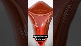 Using heated fluid to stop heavy periods 3D Animation [upl. by Sugirdor774]