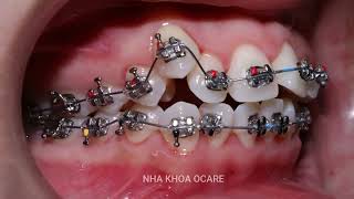 Braces process in 2 years [upl. by Rothstein]