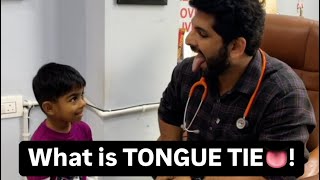 What to do in Tongue tie👅 tonguetie tongue speechdelay ankyloglossia [upl. by Sonnie]