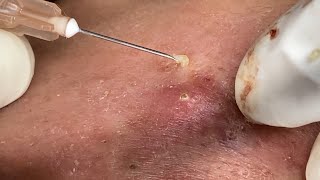 Big Cystic Acne Blackheads Extraction Blackheads amp Milia Whiteheads Removal Pimple Popping [upl. by Pritchett]