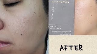 Exuviance retinol correcting peel  review  tutorial alazaesbeauty [upl. by Ymerej136]