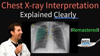 Chest X Ray Interpretation Explained Clearly  How to read a chest Xray [upl. by Ahcorb]