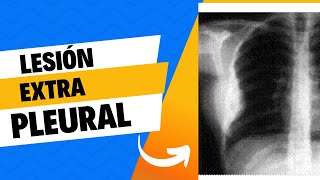 Lesión extrapleural radiografía de tórax [upl. by Asiral]