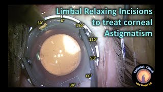 Limbal Relaxing Incisions to treat corneal astigmatism during cataract surgery [upl. by Wendi]