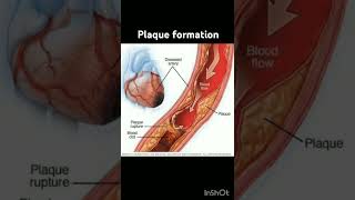 Plaque formation music viralshort education norcetseries norcetstudytips medicaleducation [upl. by Ledairam]