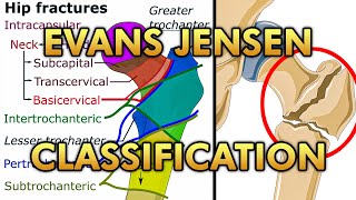 Evans Jensen Classification of Intertrochanteric Fractures of The Hip [upl. by Yrocej630]