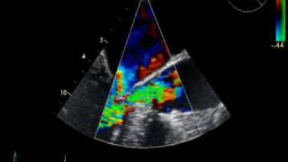 SEVERE AORTIC REGURGITATION  RHEUMATIC DISEASE ECHOCARDIOGRAPHY cardiac ultrasound [upl. by Anilet902]