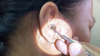 Massive Hard Dry Earwax Removed from Womans Ear [upl. by Beekman927]