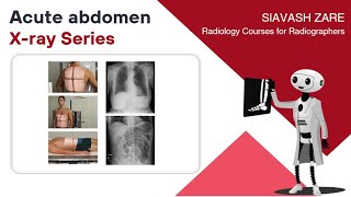 Acute abdomen xray series  indication projection technique [upl. by Ellerihs]