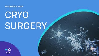 Cryo Surgery Procedure Freezing [upl. by Haydon]