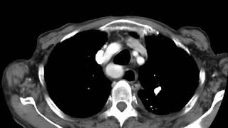 Retrosternal goitre Ahuja AT et al 2017 Book Essential Radiology [upl. by Warren609]