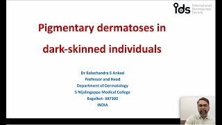 Pigmentary Dermatosis in dark skinned individuals  Dr Balachandra Ankad [upl. by Laurence]