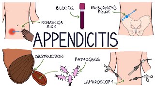 Understanding Appendicitis [upl. by Aibos651]