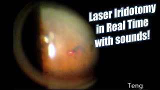 Laser Iridotomy in Real Time with Laser Sounds Chris Teng MD [upl. by Annaes]