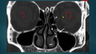 OSTEOMEATAL COMPLEX UNIT OMC ON CT ANATOMY SIMPLIFIED [upl. by Enilraep]