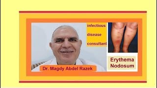 Erythema Nodosum treatment [upl. by Purcell526]