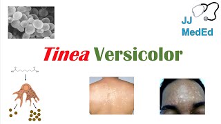 “Fungal Skin Infection of Many Colors” Tinea Versicolor  Pathogenesis Symptoms and Treatment [upl. by Ratha]