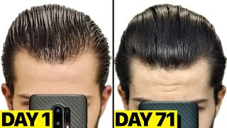 My INSANE Finasteride amp Minoxidil 25 Months Results [upl. by Jessamyn]