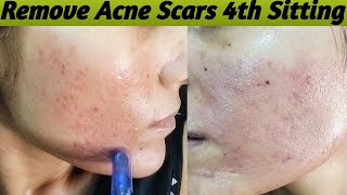 Reduce Acne Scars Day By Day  Before amp After Skin  Part4 acnescars chikenpoxscarsremove [upl. by Renelle]