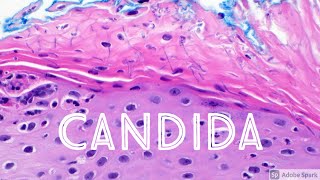 Candida Yeast Infection under microscope Candidiasis Dermatology Dermatopathology [upl. by Ellebasi436]