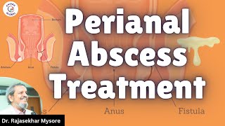 Perianal Abscess Treatment  Dr Rajasekhar Mysore  Chirag Global Hospitals [upl. by Reinald127]