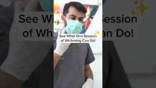 After one session of teeth whitening  Before After results whiteteeth teethwhitening shorts [upl. by Serrano116]