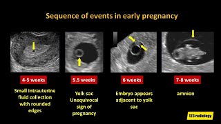 Early Pregnancy Failure A simplified Ultrasound Approach [upl. by Steffi639]