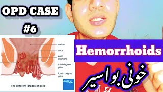 Hemorrhiods ❤️ General OPD CASE 6❤️ hemorrhoids piles بواسیر Treatment medication [upl. by Marj]