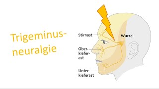 Trigeminusneuralgie [upl. by Dlabihcra146]