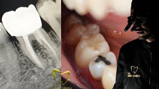 Furcation Perforation Repair Protocol  Restoring Badly Destructed Tooth  Dental Case [upl. by Lenra97]