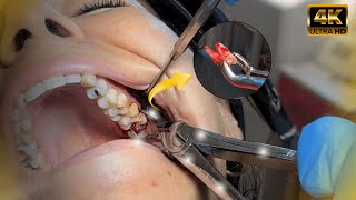 AMAZING Extraction of Wisdom Tooth Using Forceps [upl. by Gusta970]