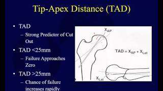 Proximal Femur Fractures 4 Intertrochanteric Hip Fractures [upl. by Jannelle]