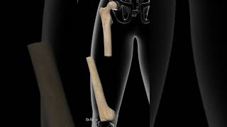 4 Most Painful Femur Shaft Fractures [upl. by Eneryc739]