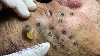 Big Cystic Acne Blackheads Extraction Blackheads amp Milia Whiteheads Removal Pimple Popping 0294 [upl. by Eserehs984]