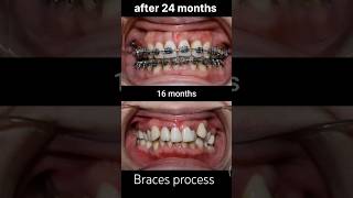 braces process after 24 months braces transformation braces orthodontist dentist shorts viral [upl. by Atinev]