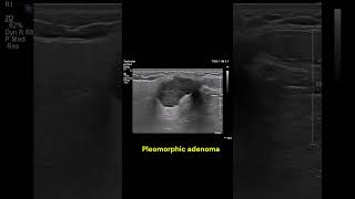 Parotid gland mass 1 imaging ultrasound radiology salivaryglands cases [upl. by Adnilg]