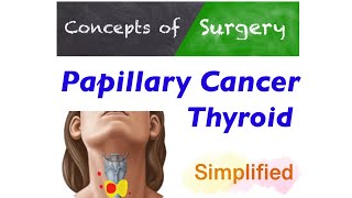 Thyroid papillary cancer Most Simplified Approach to Management [upl. by Magner]