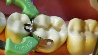 Composite Fill Walkthrough tutorial for 19 MO Approximal Box and Occlusal Fill [upl. by Oleusnoc]