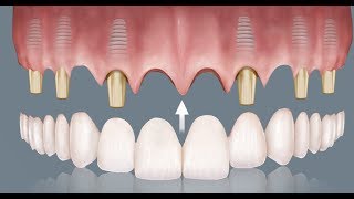 Prótesis fija sobre Implantes  Madrid [upl. by Towroy]