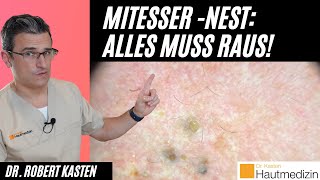 Ein Beet aus Mitessern ALLES MUSS RAUS M FavreRacouchot an der Schläfe [upl. by Artie]