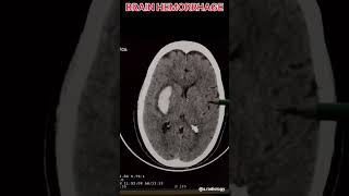 BRAIN HEMORRHAGE CT SCAN RADIOLOGY [upl. by Maryn257]