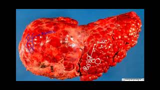 Patofisiologis Sirosis Hepatis [upl. by Maurer]