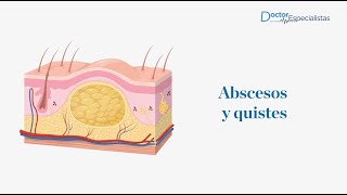 Abscesos y quistes  Doctores Especialistas [upl. by Lussier524]