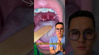 Amigdalitis bacteriana parte 1  Dr William Guerrero medicina shorts [upl. by Noami697]