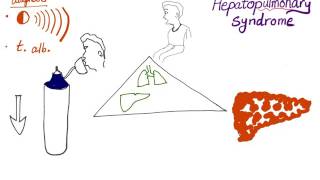 Hepatopulmonary syndrome the clinical triad [upl. by Eerat444]