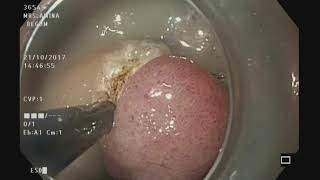 ESD for adenomatous gastric polyp [upl. by Tsew]