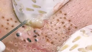 NEW Pimple Popping Compilation  Blackheads removal  Pimple removal vids of 2021 [upl. by Laurita]