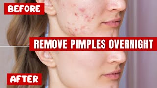 How to Treat Acne at Home That Works Amazingly [upl. by Babby]