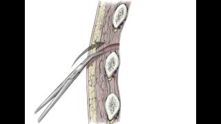 Empyema Thoracis  Surgical Management [upl. by Lusar]