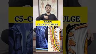 Exercise for Cervical C5C6 Disc Bulge Relief shortvideo tranding exercise [upl. by Flatto]